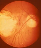 Severe,_active_retinochoroiditis_by_Toxoplasma_gondii.jpg