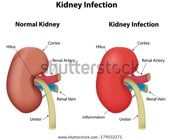 kidney-infection-600w-179032271.jpg