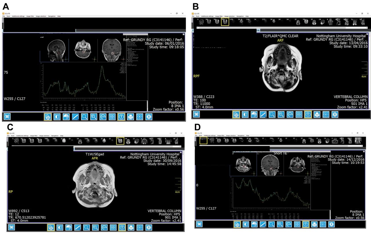 ependymoma1.jpg