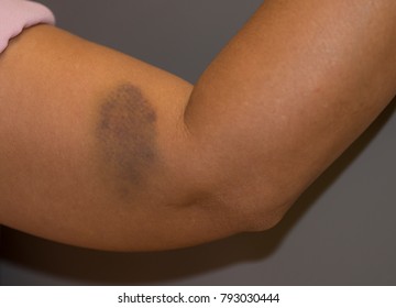 bruise-hematoma-on-wounded-woman-260nw-793030444.jpeg