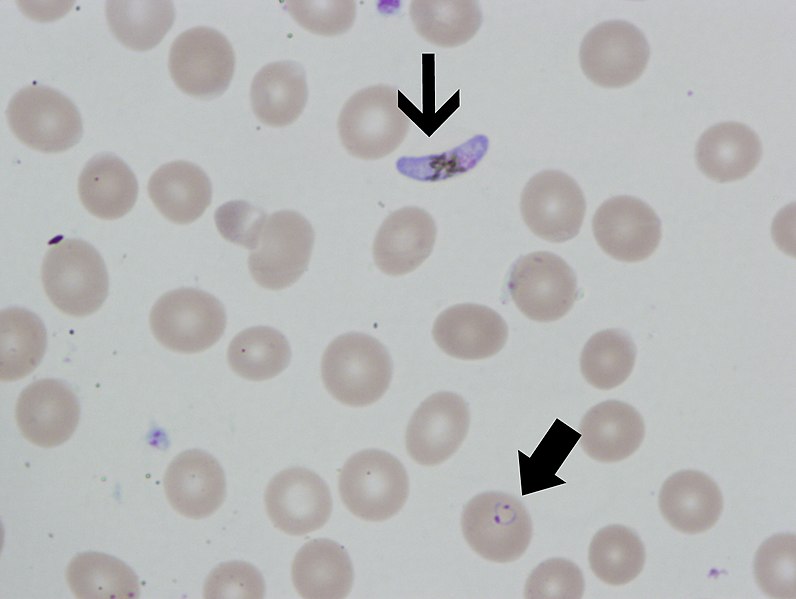 796px-P._falciparum_thin_smear_ring_forms_and_gametocyte.jpg