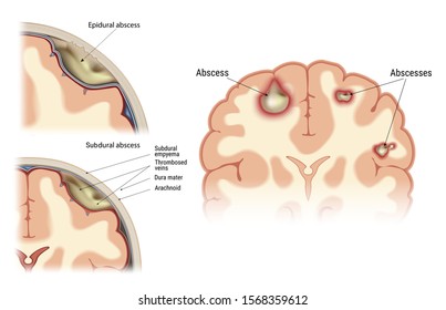 abscess-human-brain-visual-image-260nw-1568359612.jpg