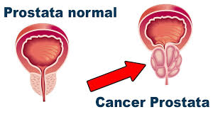 cancer de prostata.jpg