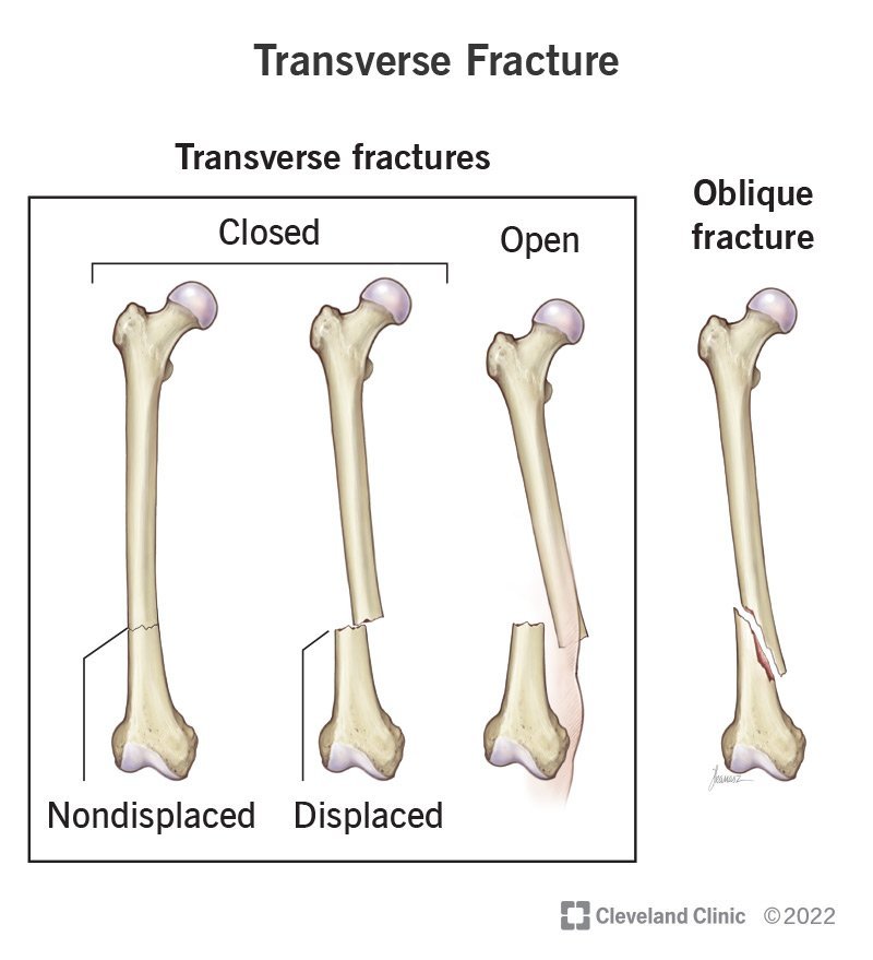 22956-transverse-fracture.jpg