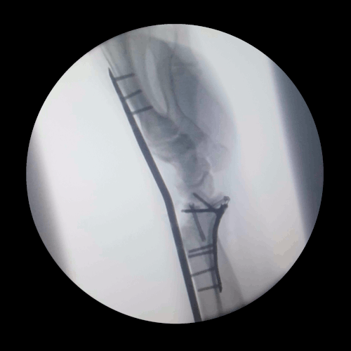 Left Arm X-Ray Animation