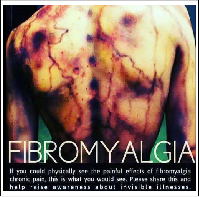 Fibro