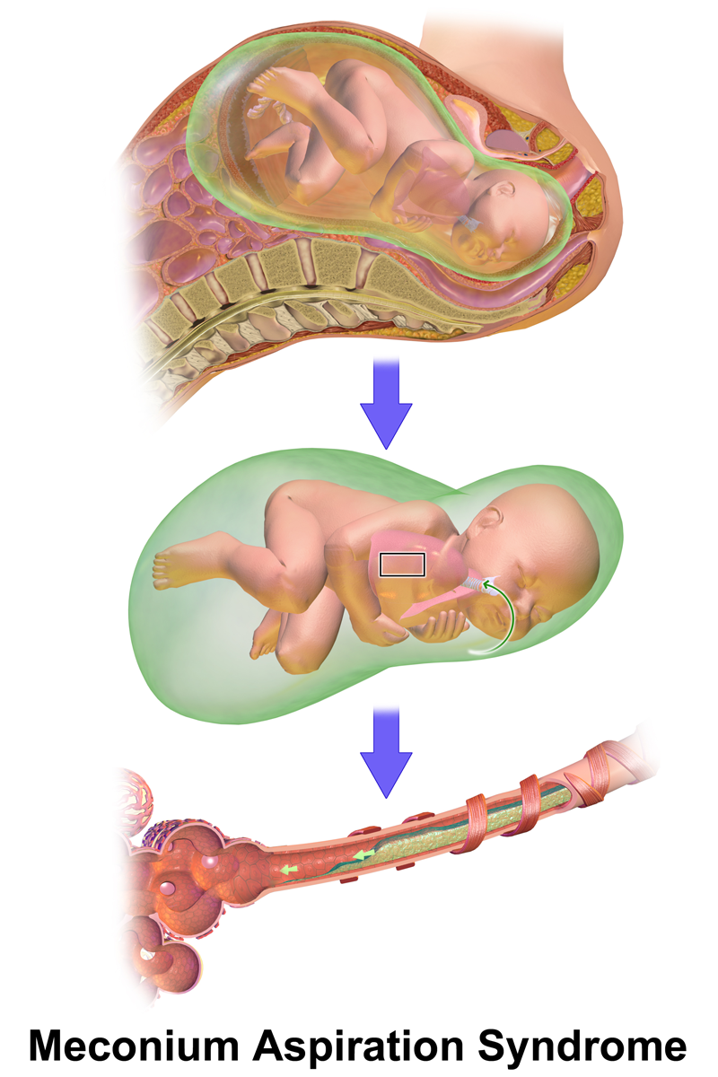 Meconium_aspiration_syndrome_(MAS).png