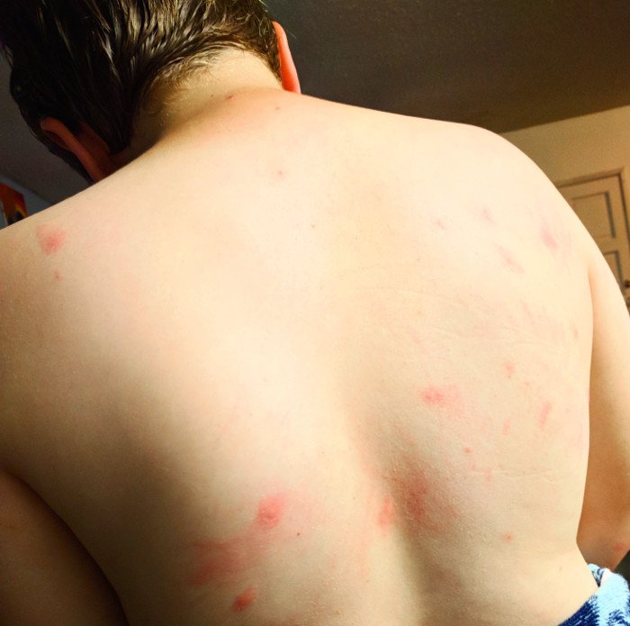 hives back b.jpg