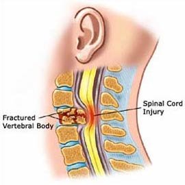 Spinal cord injury