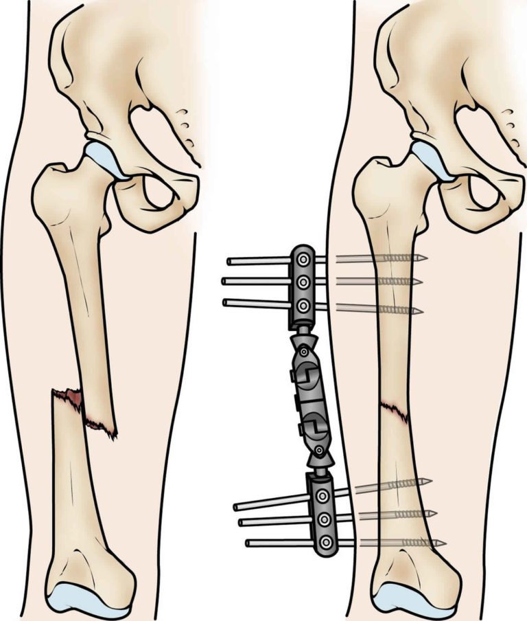 External-fixation-for-transverse-fracture-768x904.jpg