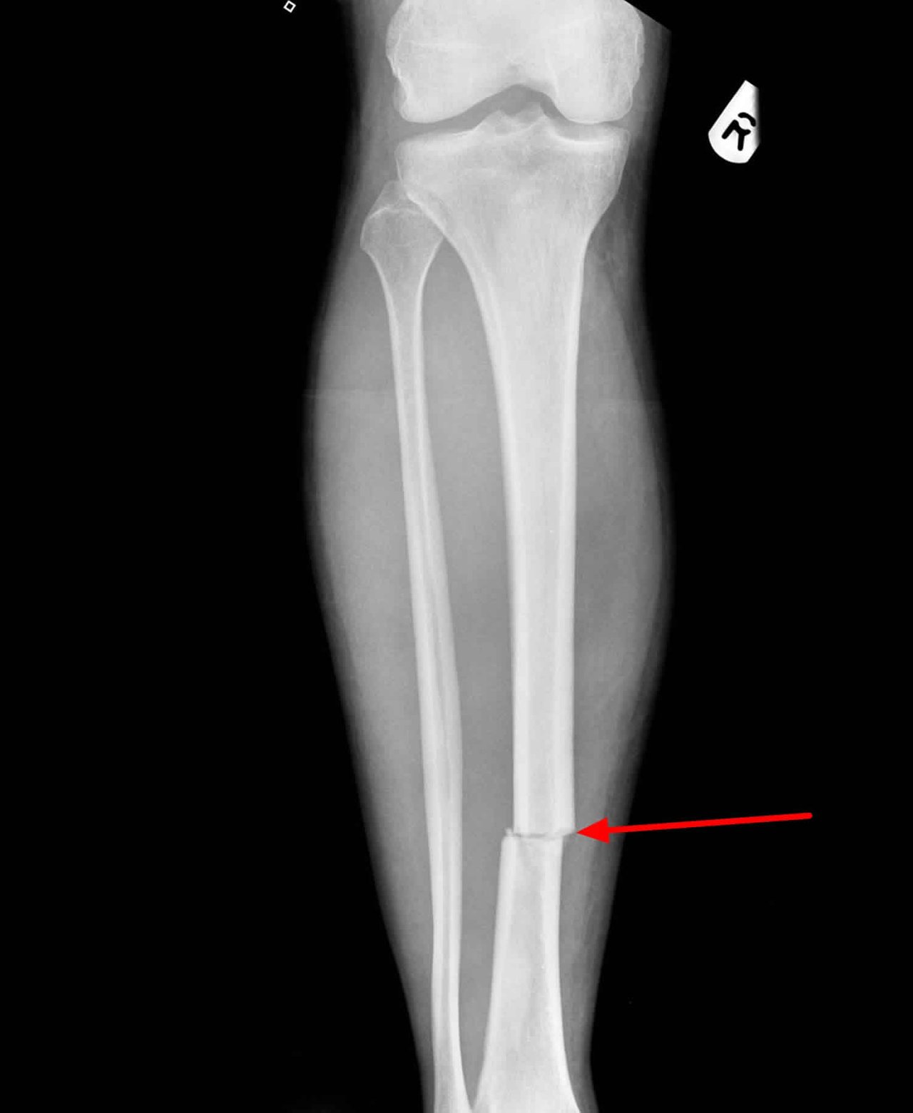 Transverse-fracture.jpg